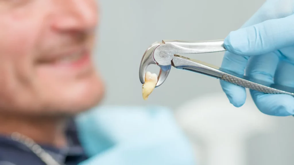 A close-up of a dental extraction with forceps holding a tooth, showing a dentist's hand in a gloved blue glove.