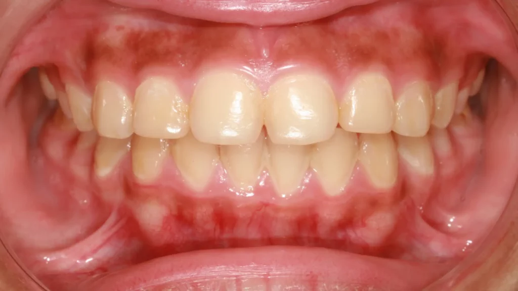 Close-up of teeth showing healthy gums.