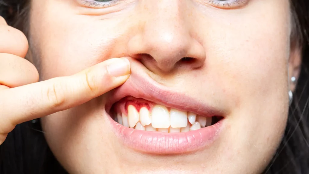 Can You Reverse Gingivitis_ Early Treatment and Prevention Image 2