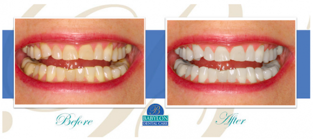 patchogue zoom teeth whitening dentists patchogue zoom teeth whitening dentists