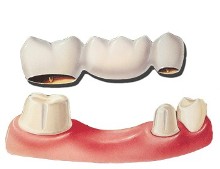 dental-bridge