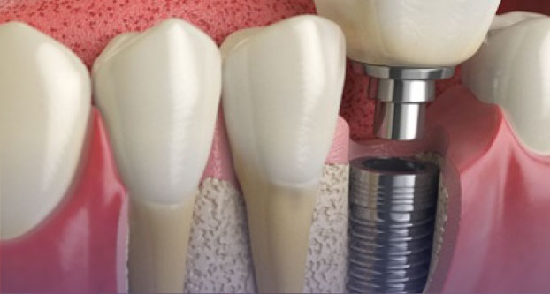 A close-up diagram of a dental implant being placed into the gum and jawbone, showing a metal post supporting a crown alongside natural teeth