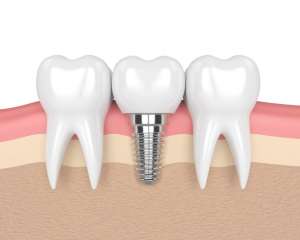 dental implant