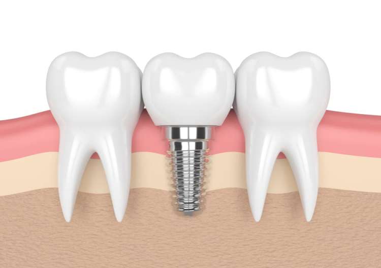 dental implant