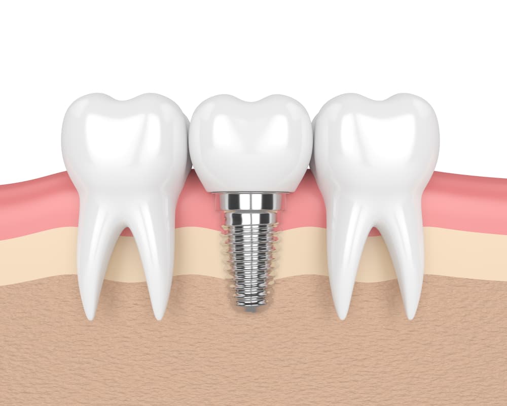 Dental Implants Albany Ny