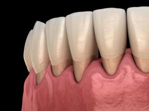 gum disease image