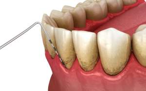 gum disease plaque