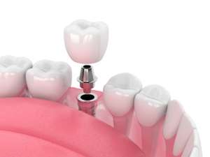 Does Dental Insurance Cover Implants?