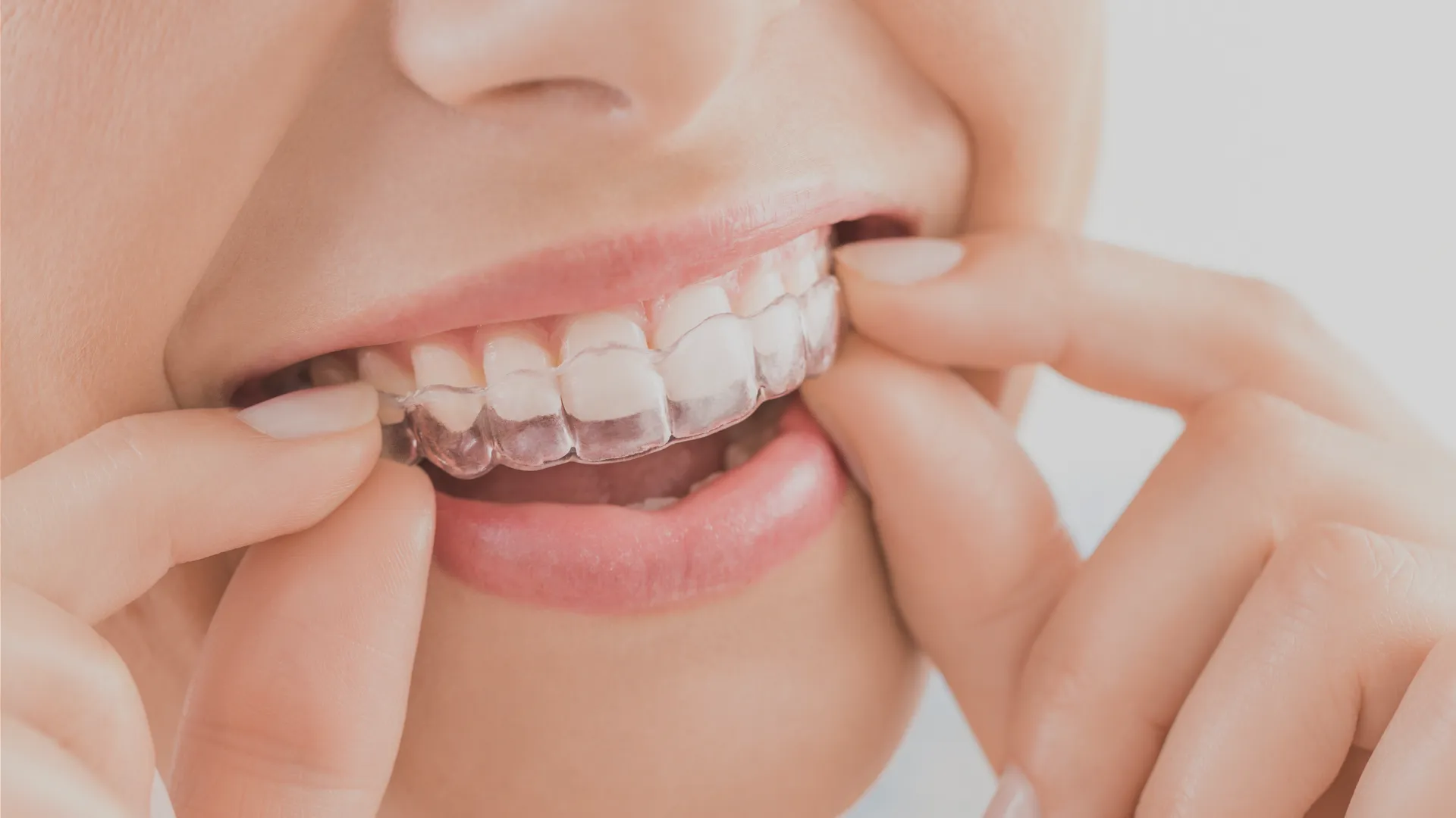 Teeth Whitening Dental Insurance