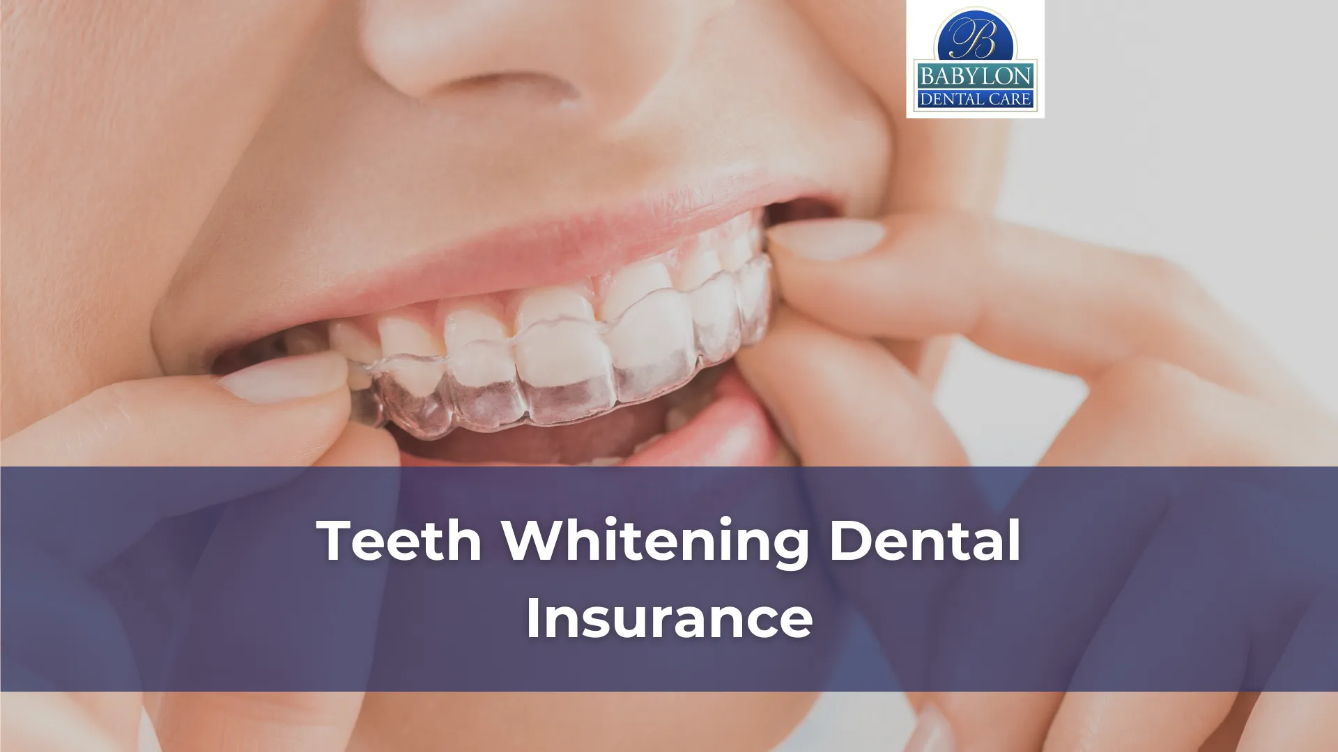 Teeth Whitening Dental Insurance