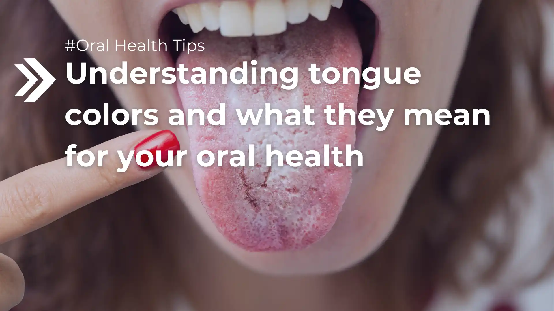 Understanding tongue colors and what they mean for your oral health image