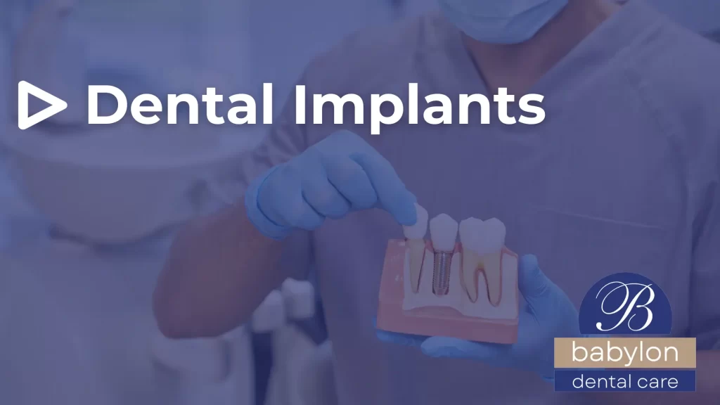 Dental Implants