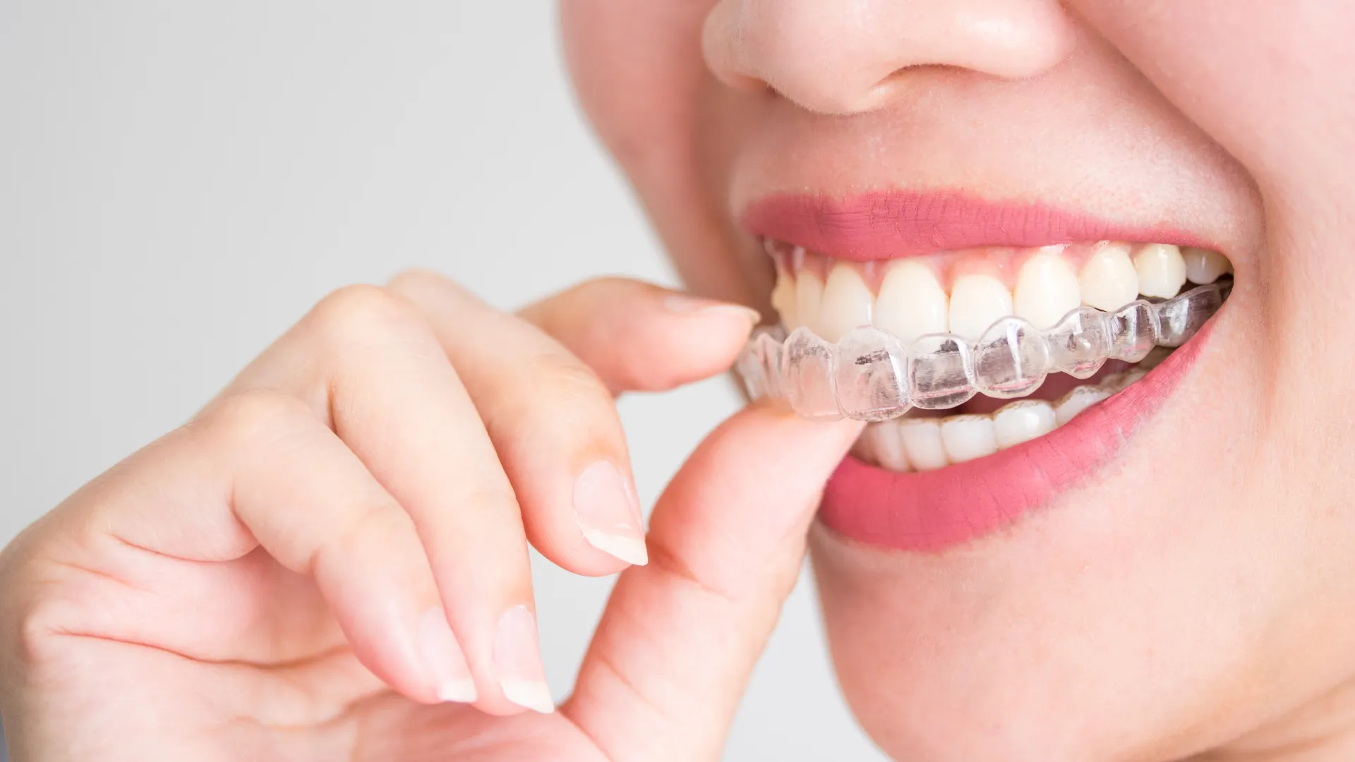 how much does invisalign cost