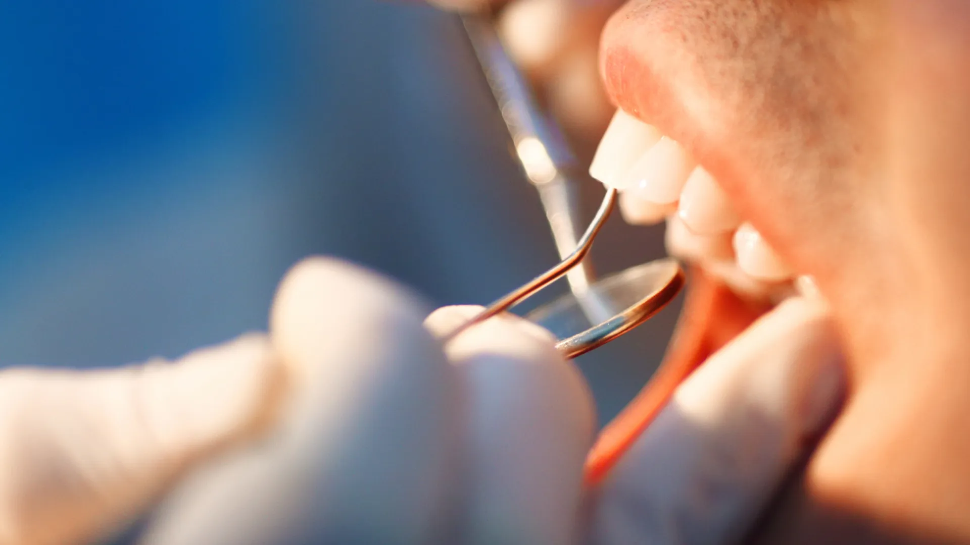  a person's mouth doing dental bonding with a mirror