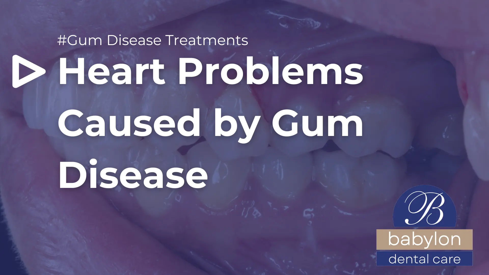 Heart Problems Caused by Gum Disease