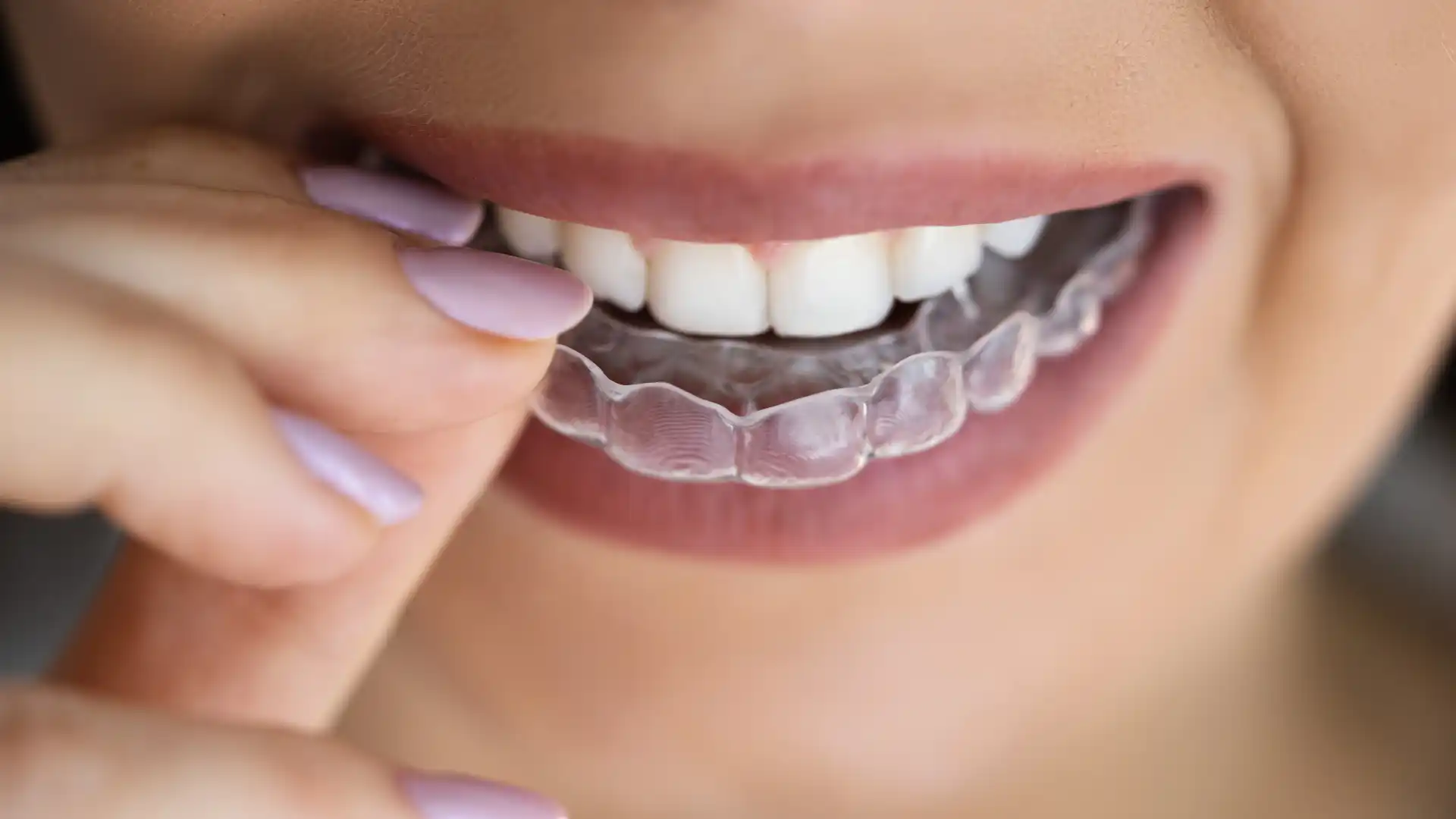 Close-up of a woman inserting a clear aligner over her teeth.