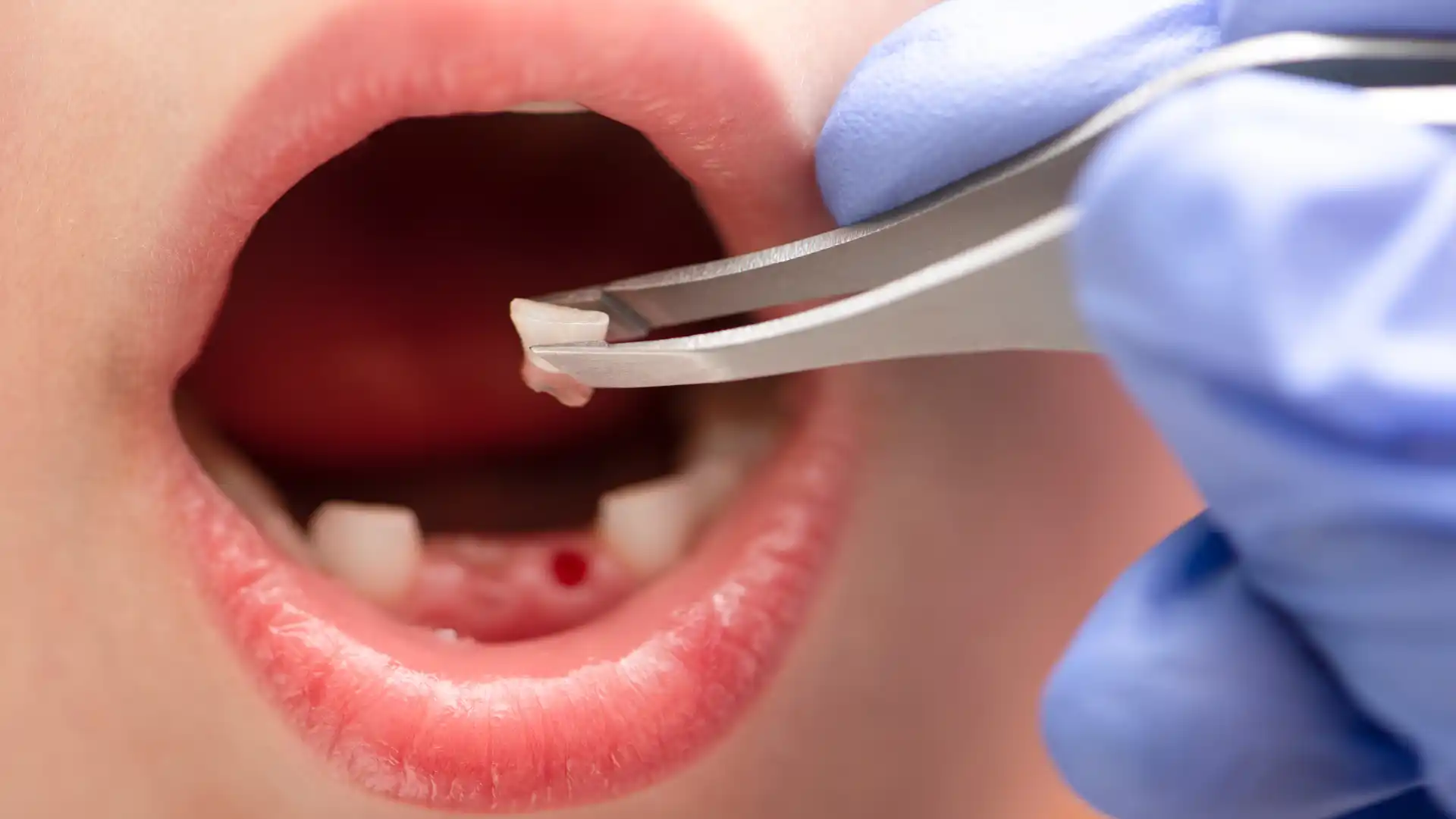 Tooth extraction site with gauze application