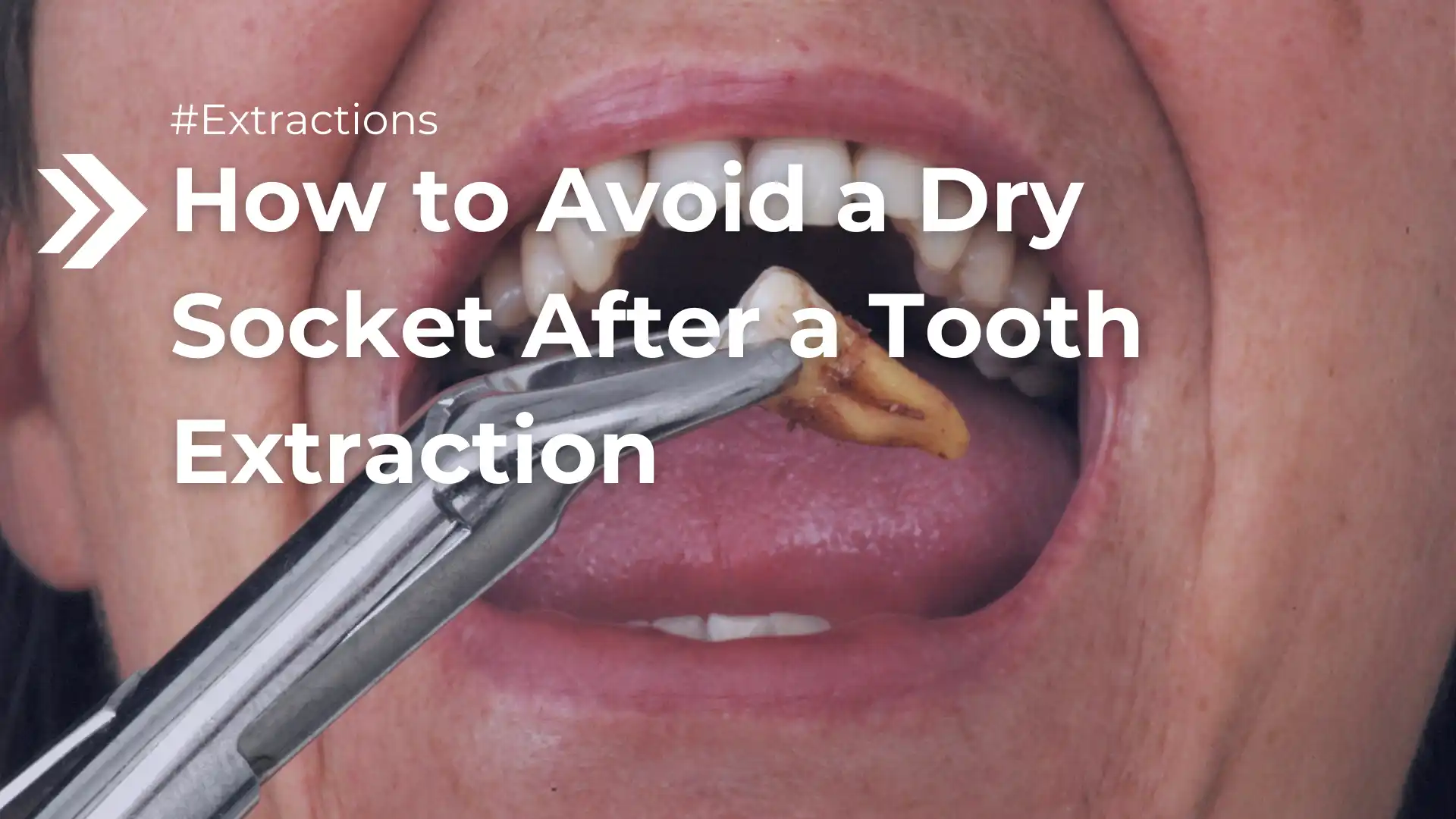 How to Avoid a Dry Socket After a Tooth Extraction Image