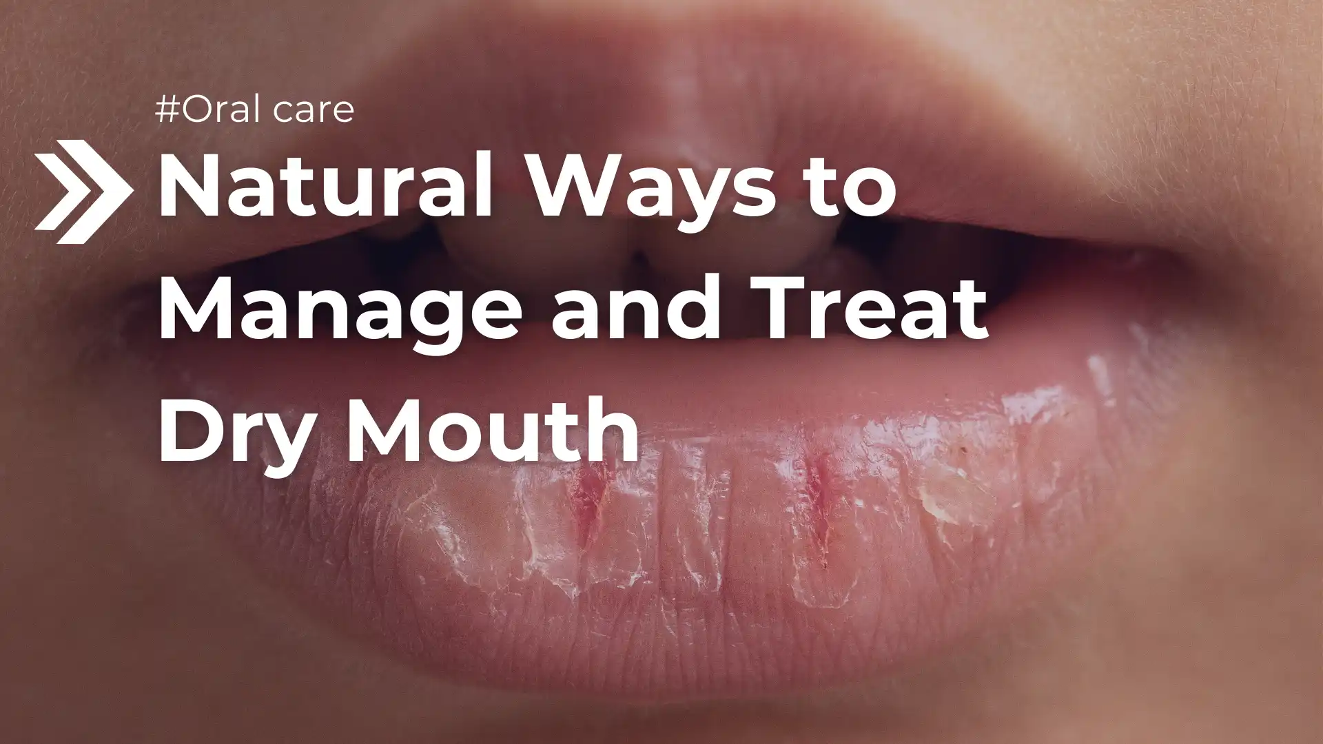 Natural Ways to Manage and Treat Dry Mouth Image