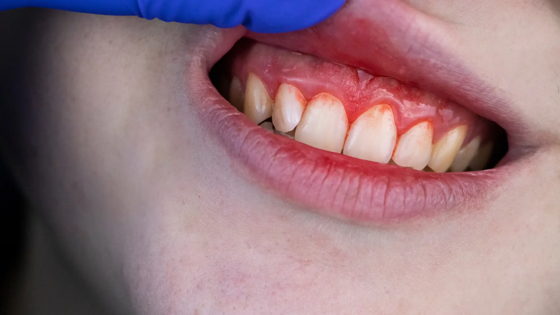 A close-up of a person's teeth and gums being examined by a gloved hand, showing signs of gum inflammation or irritation