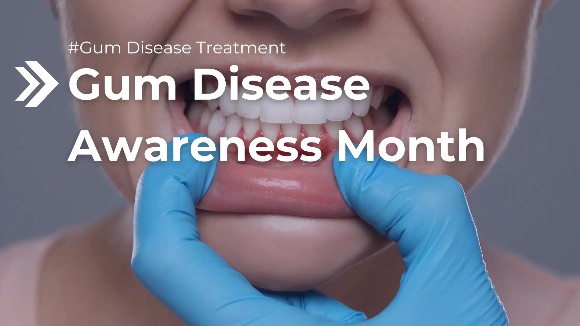 Gum Disease Awareness Month Image