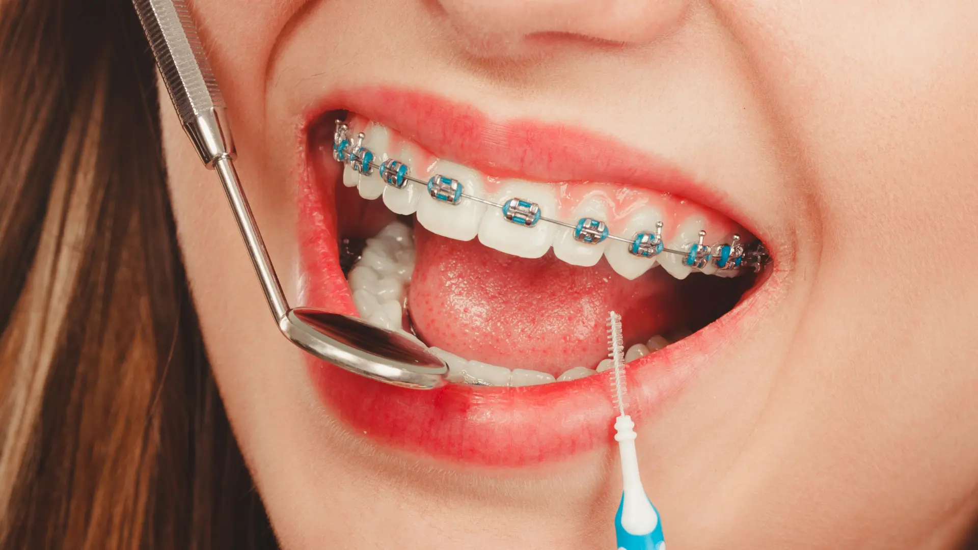 Close-up of a person with braces receiving dental care using a mirror and interdental brush.