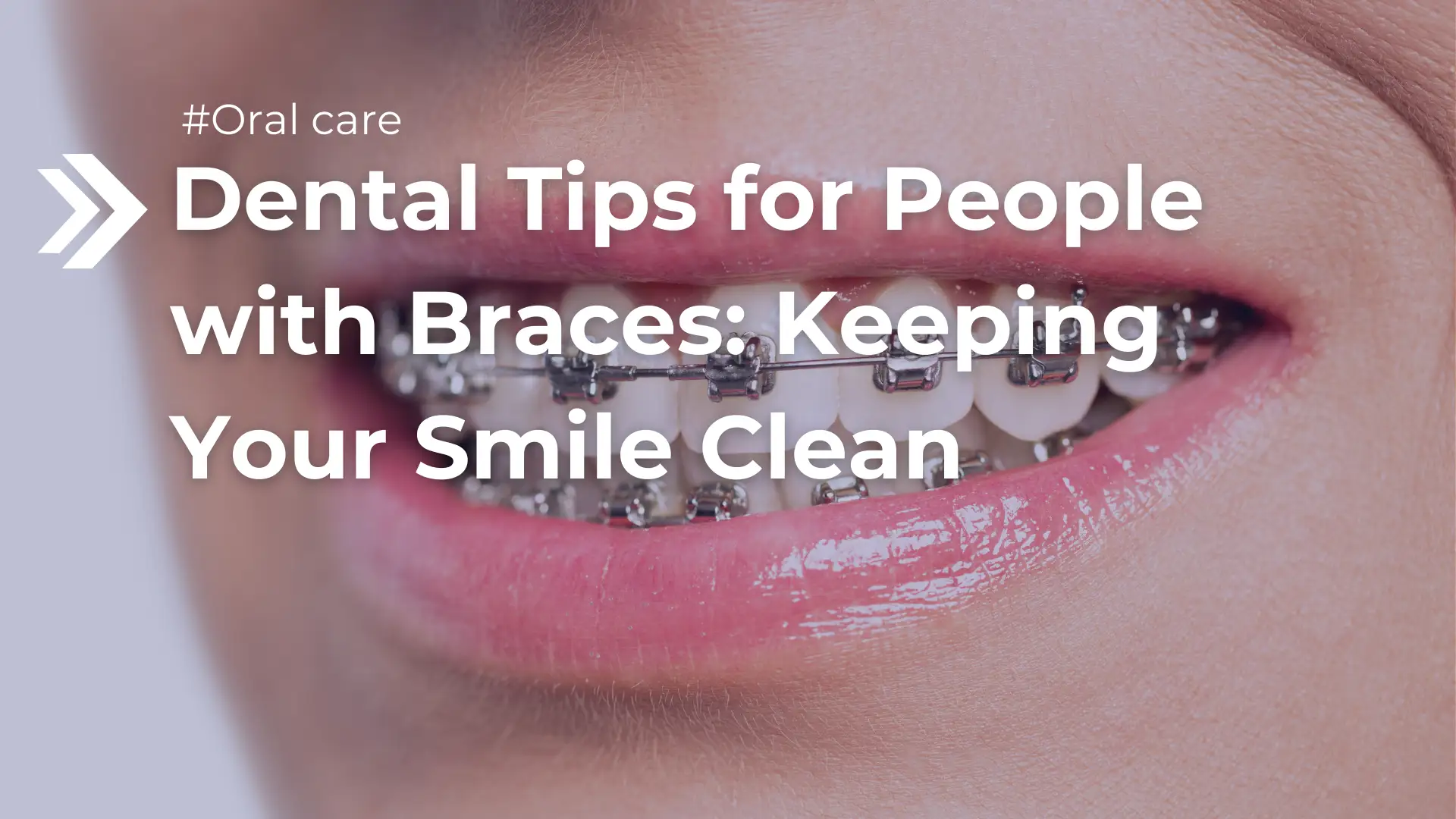 Dental Tips for People with Braces_ Keeping Your Smile Clean image