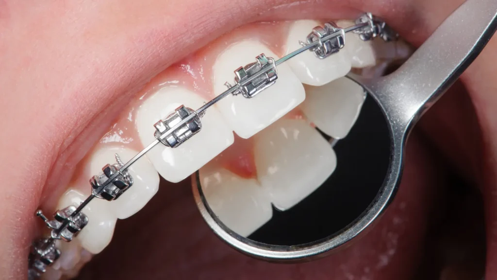 Close-up of a set of metal braces on the teeth, with an orthodontic mirror reflecting the dental structure.