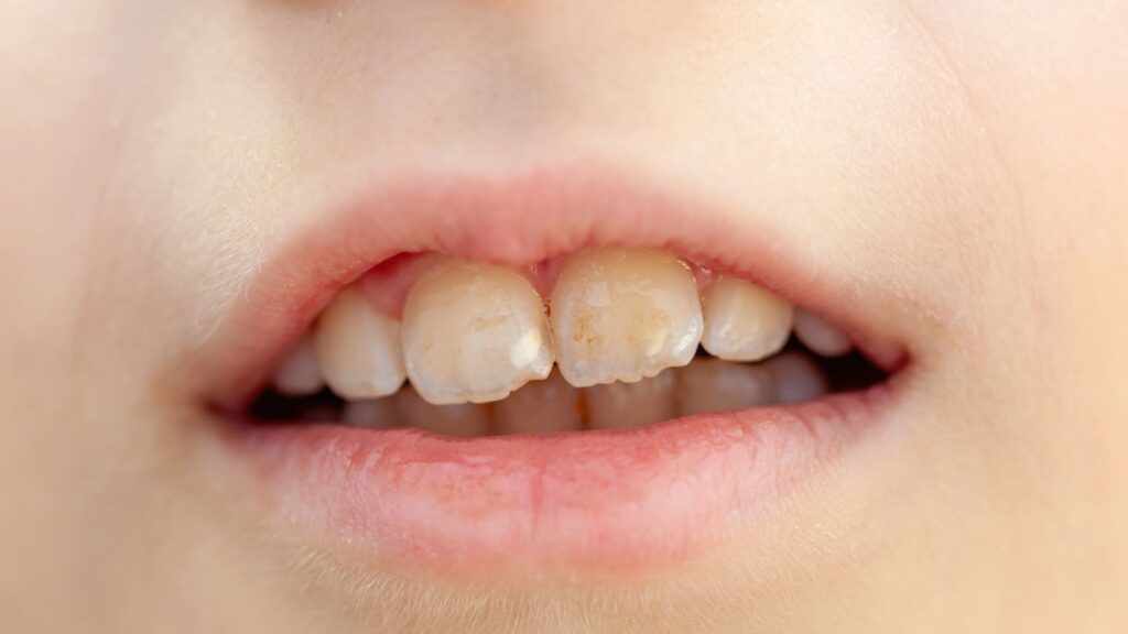 Are Sports Drinks Bad for Your Teeth_ The Truth About Enamel Erosion image 2