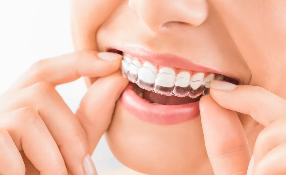 Person inserting a clear aligner over their teeth.